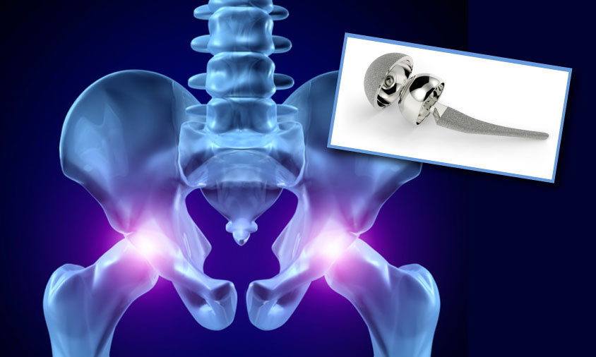 Hip Replacement Clark Law Firm